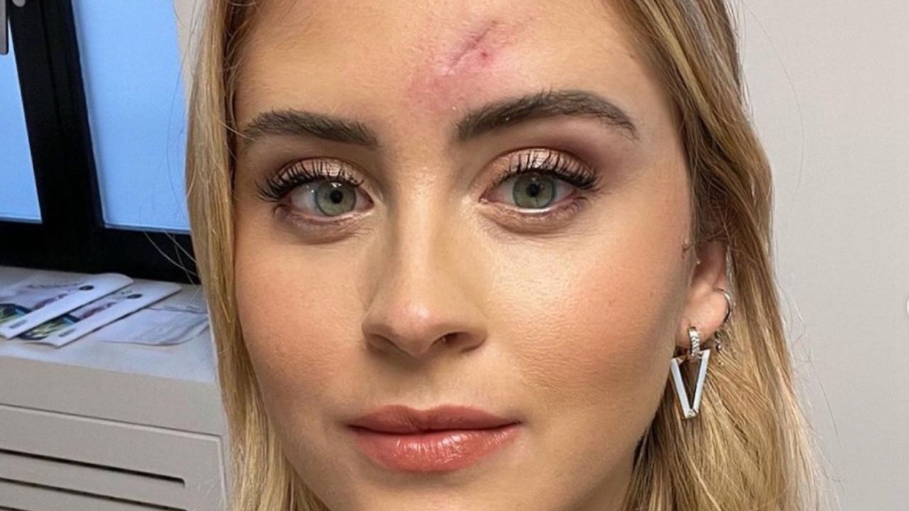 Valentina Ferragni dopo l'operazione