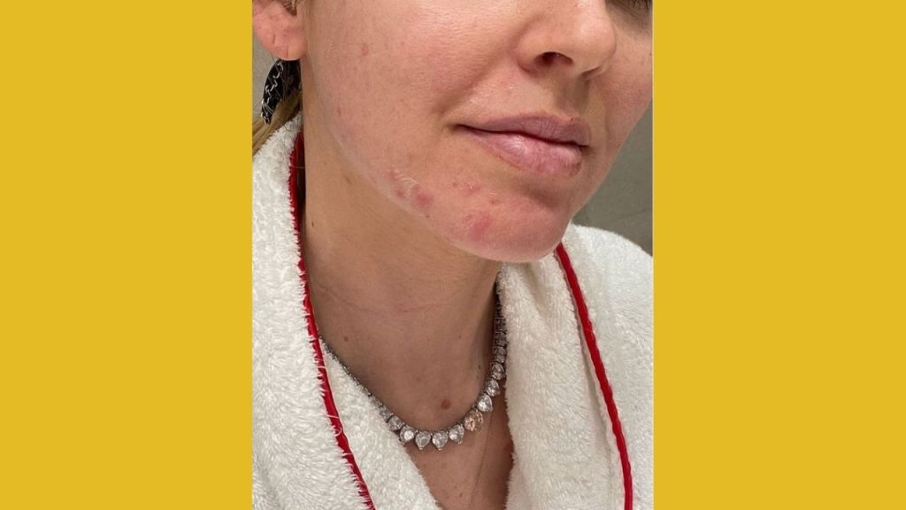 Il post di Chiara Ferragni in cui parla dell'acne.