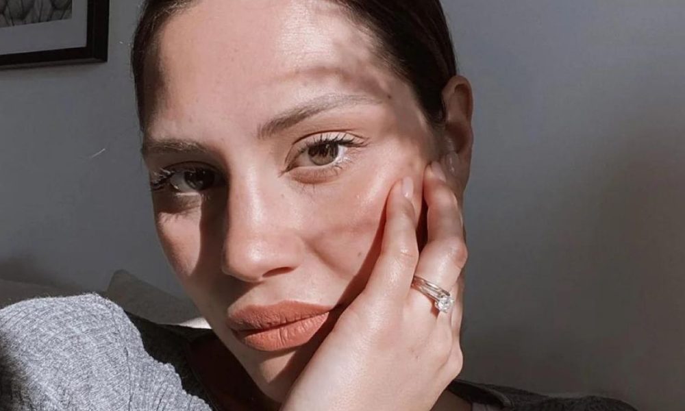 Beatrice Valli mostra lo sfogo sul viso: l’imprevisto a qualche ora da Sanremo