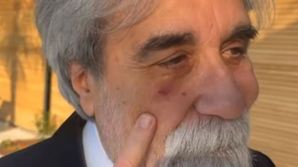Beppe Vessicchio a Sanremo con un occhio nero: cos'è successo 42 beppe vessicchio occhio nero sanremo