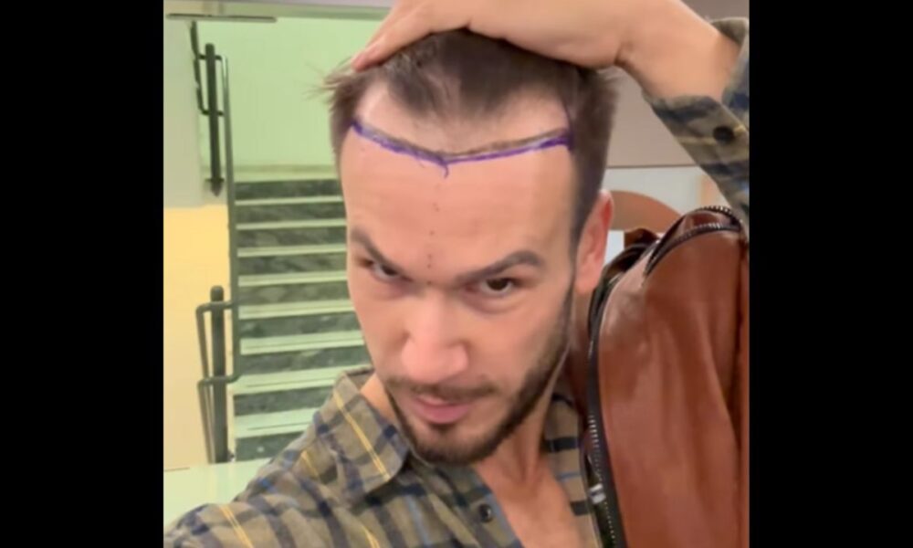 La rabbia di Matteo Diamante dopo il trapianto di capelli: “Dagli amici nemmeno un ‘come stai'”
