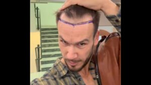 La rabbia di Matteo Diamante dopo il trapianto di capelli: “Dagli amici nemmeno un ‘come stai'”
